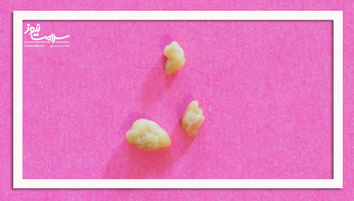 آیا دندان عقل می تواند باعث سنگ لوزه شود؟