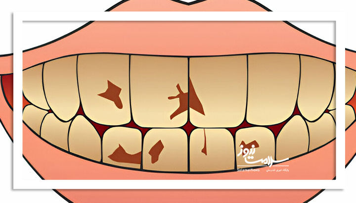 دندان‌های مبتلایان به رفلاکس معده در معرض خطر