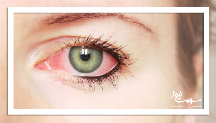 از ویروس چشمی چه می دانید؟