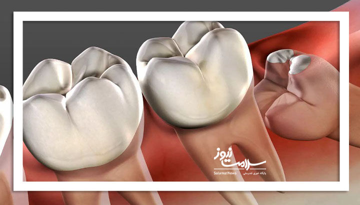 رازهای دندان عقل؛ از نهفتگی تا ناپدید شدن!
