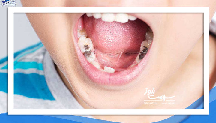 تبعات بی توجهی به سلامت دندان کودکان