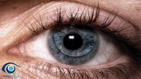 تحولی شگفت انگیز، با لنز نوع اسکلرال دیگر مشکل قرنیه چشم وجود نخواهد داشت | نوین لنز