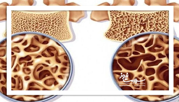آلو خشک؛ راهی طبیعی برای تقویت استخوان‌ها و کاهش خطر پوکی استخوان در زنان یائسه