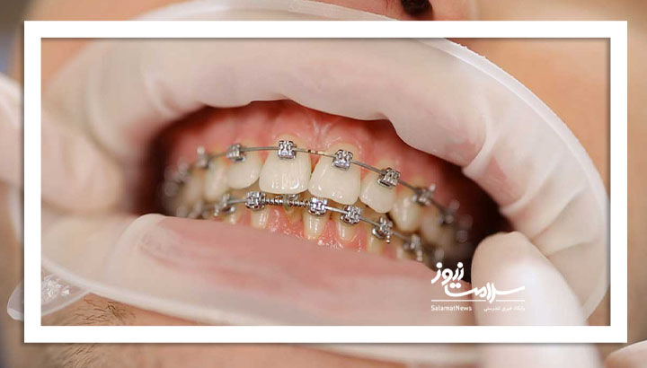 چرا رعایت  بهداشت در ارتودنسی دندان اهمیت بیشتری دارد؟