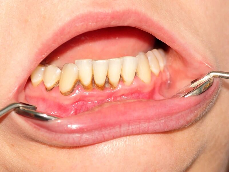 7 علت پوسیدگی دندان از کنار لثه