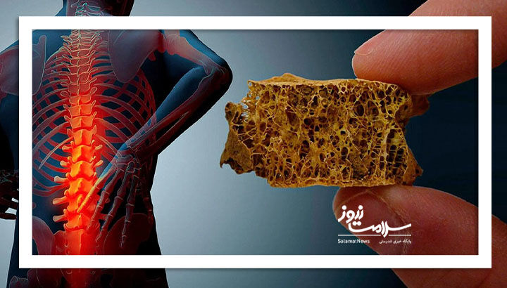 مهم ترین کلید پیشگیری از پوکی استخوان