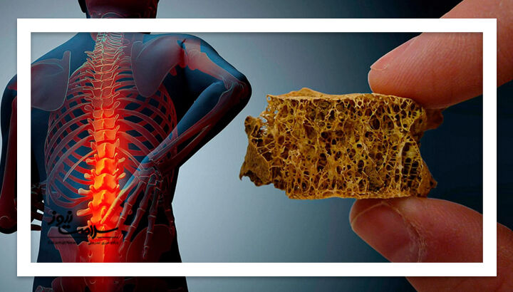 علل پوکی استخوان؛ از کم‌وزنی تا دخانیات و الکل
