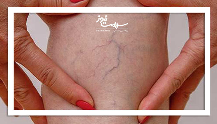 چرا واریس خطرناک است؟