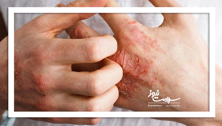 راهکارهای ساده برای کنترل اگزما