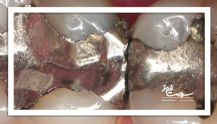 آیا آمالگام سمی است؟