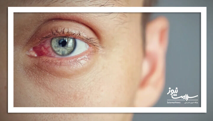 روش های کنترل خشکی چشم در زمستان