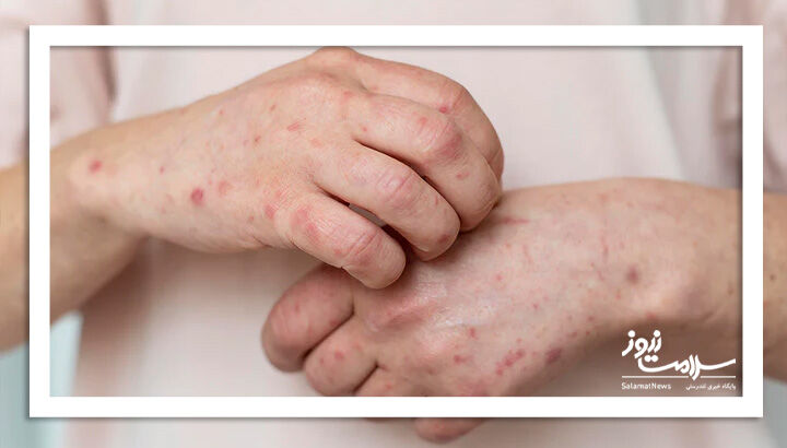 آلودگی هوا و تأثیر مخفی آن بر پوست: پیری زودرس و التهاب در کمین