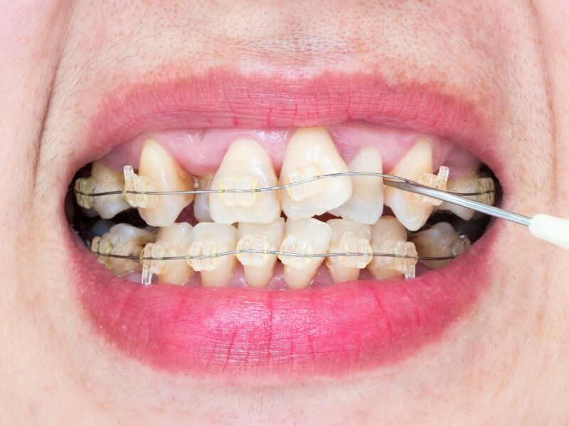 چرا گاهی دندان ها بعد از ارتودنسی باز می گردند؟!