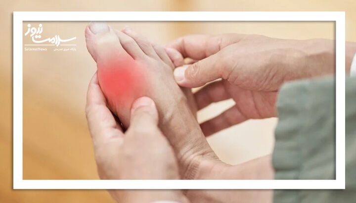 نقرس؛ بیماری مفاصل یا سبک زندگی؟ روش‌های پیشگیری و درمان این بیماری التهاب مفصلی