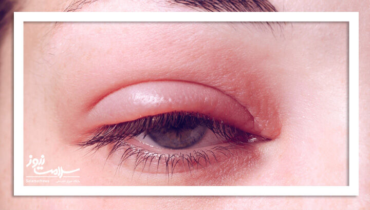 عفونت انگلی آکانتامبا؛ خطر تشخیص اشتباه و از دست رفتن دائم بینایی