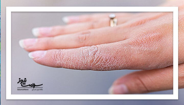 خطاهای رایج پوستی در هوای سرد