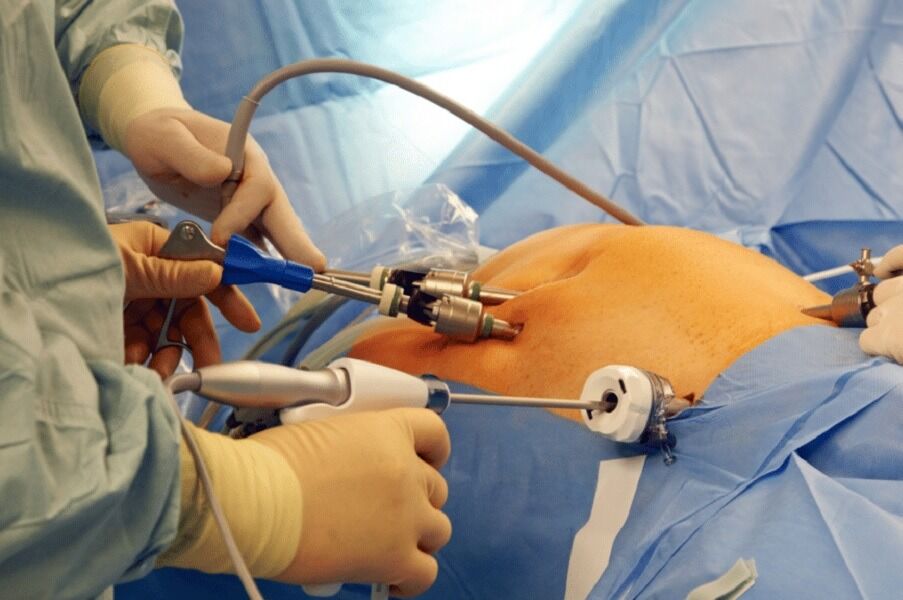 آیا اسلیو معده خطرناک است؟