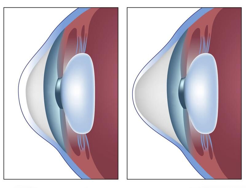 قوز قرنیه چیست؟ علت، علائم و جدیدترین روش‌های بهبود قوز قرنیه