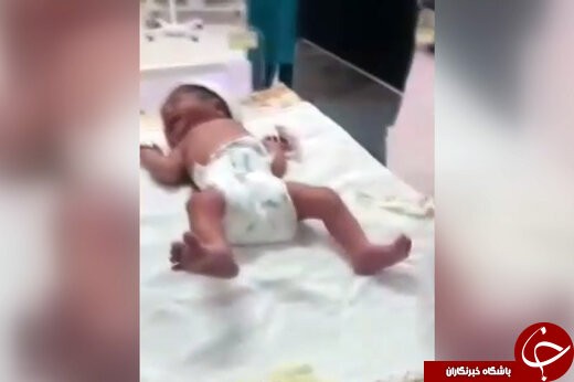 ماجرای قطع انگشت نوزاد تازه متولد شده در بیمارستان چه بود؟ +فیلم