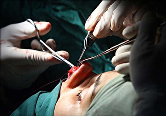 شایع‌ترین جراحی زیبایی در ایران/ حداقل و حداکثر سن برای انجام جراحی بینی