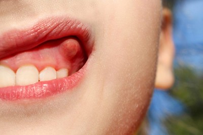 کیست دندان چیست؟ + علایم، پیشگیری و درمان
