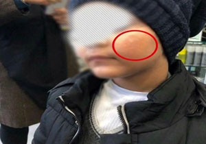 واقعیت ماجرای سوختن صورتِ پسر بچه رامسری در مهد کودک