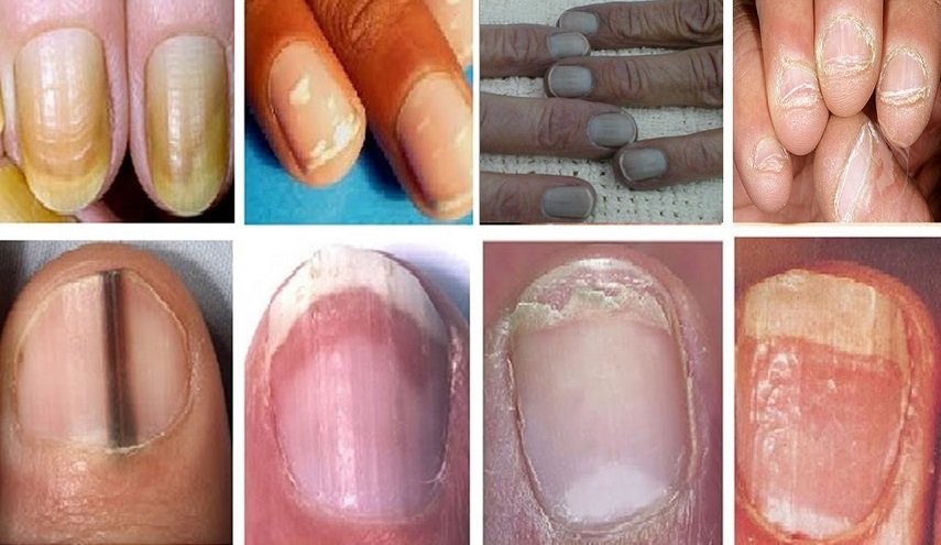 نشانه‌های هشداردهنده روی ناخن‌ها که از سرطان خبر می‌دهند