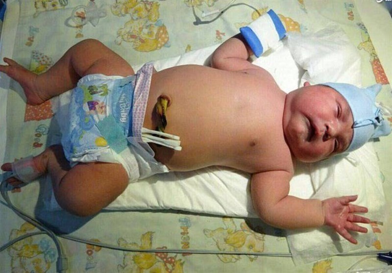 تولد نوزاد ۶ کیلویی در اردکان /علت دقیقی از افزایش وزن نوزاد در دست نیست