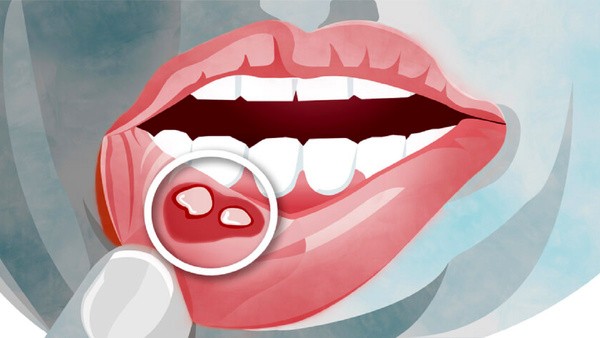 نشانه‌های مشکل دستگاه گوارش در دهان
