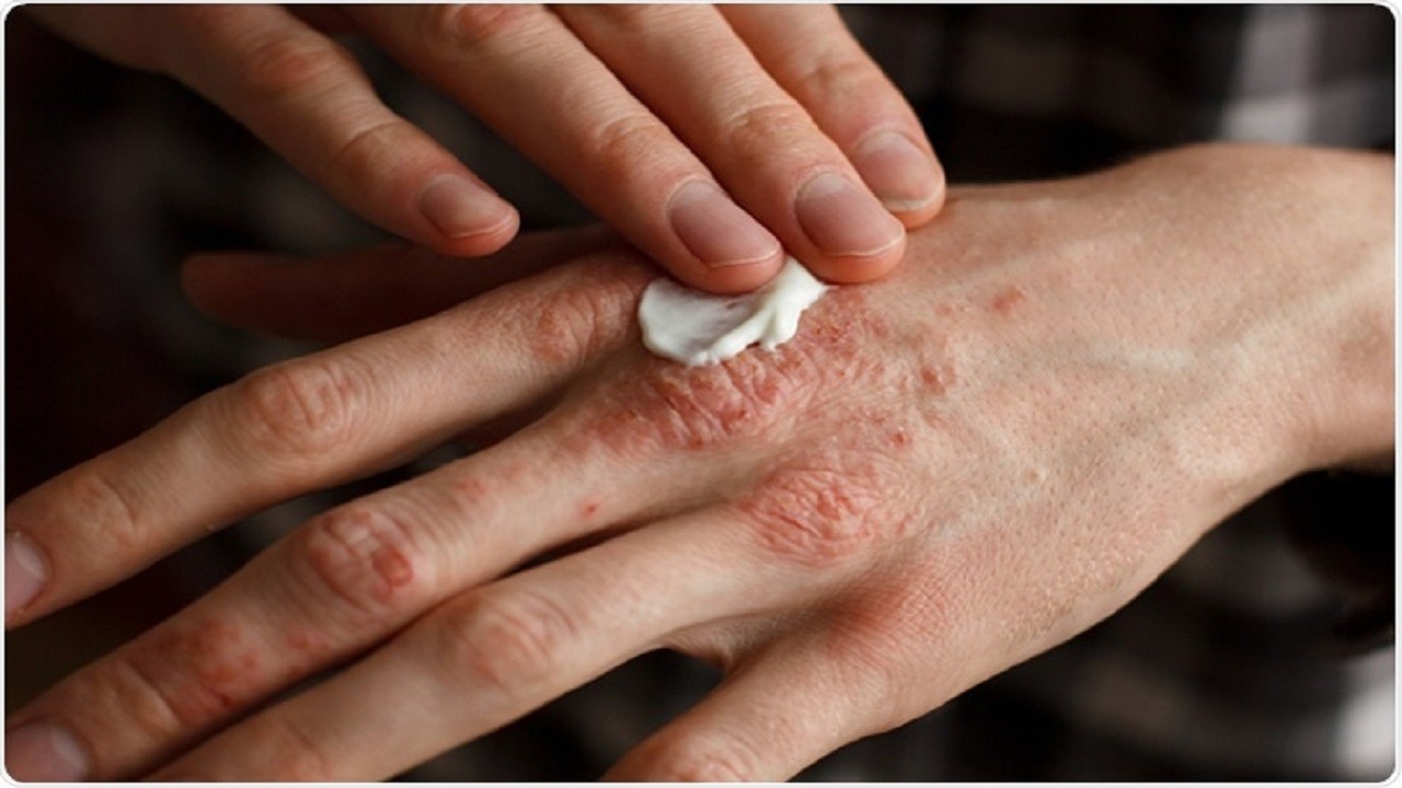 ۶ راهکار ساده برای درمان اگزمای پوستی