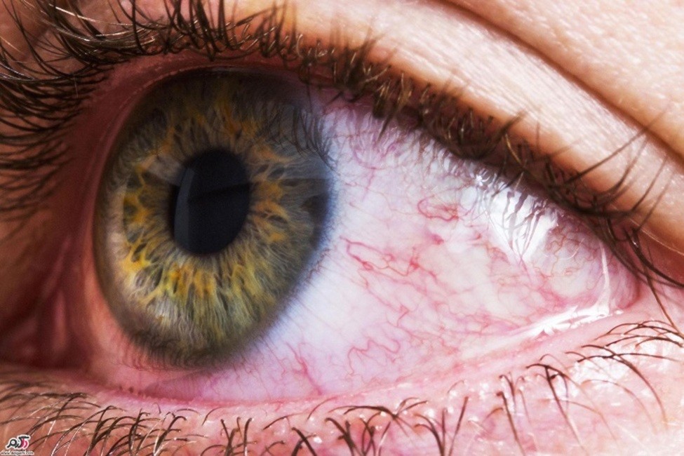 بیماری‌هایی که با نگاه در چشم تشخیص داده می‌شوند
