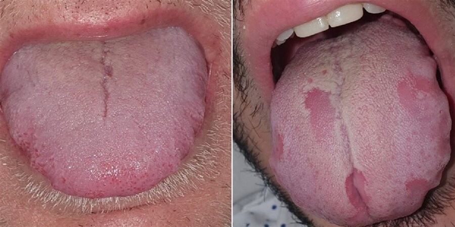 «زبان‌ کووید»: زخم‌های دهانی ممکن نشانه عفونت کروناویروس باشند