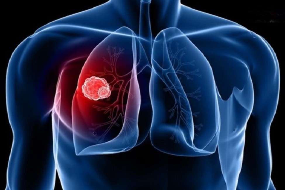 علت اصلی آمبولی ریه چیست؟