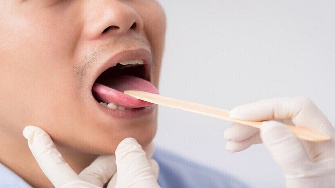 دو علامت در دهان که نشان از سطح بالای قند خون دارد