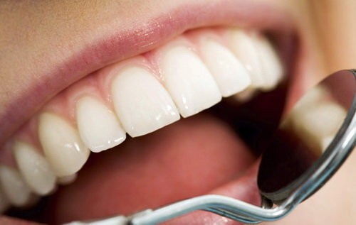 تفاوت لمینت و کامپوزیت دندان‌ها
