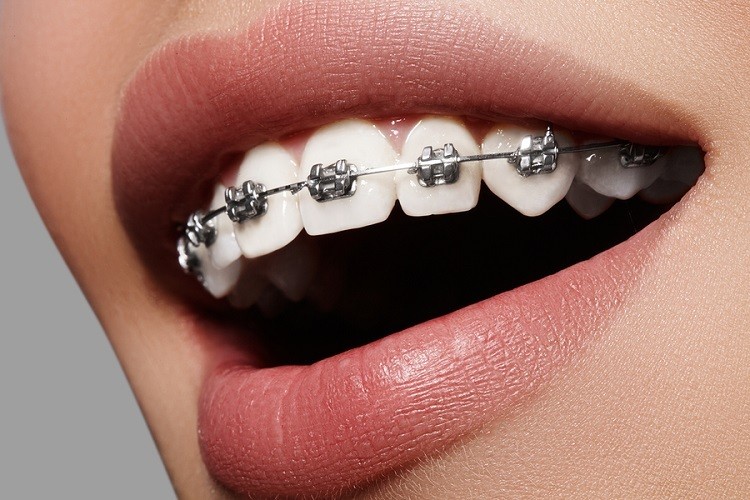 هرآنچه درباره ارتودنسی دندان باید بدانید