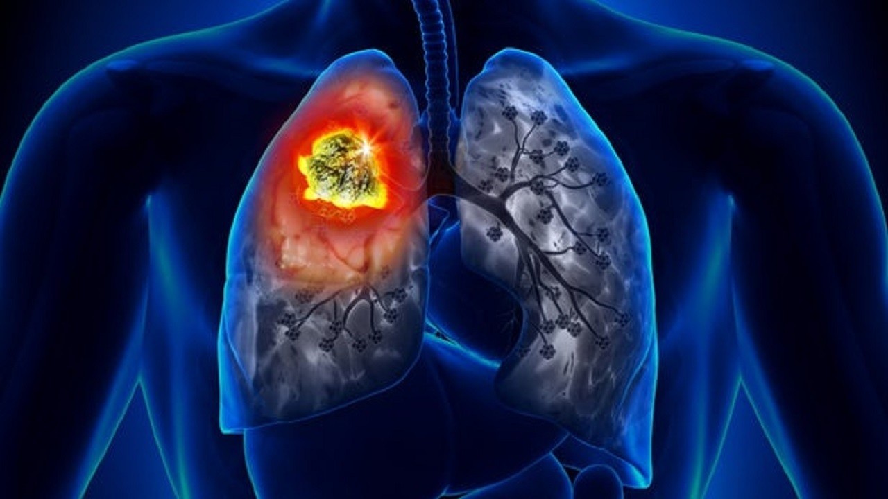 مهمترین نشانه سرطان ریه را بشناسید