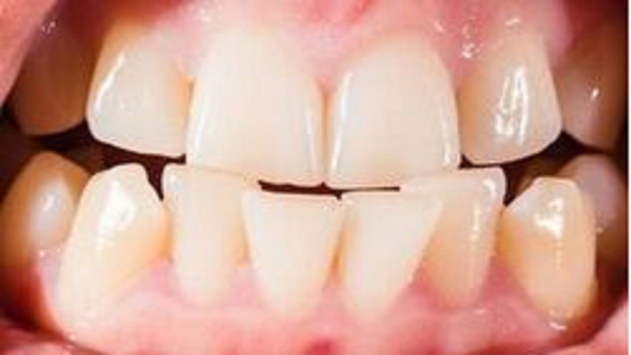 رعب آورترین عوارض تراکم و فشردگی دندان‌ها