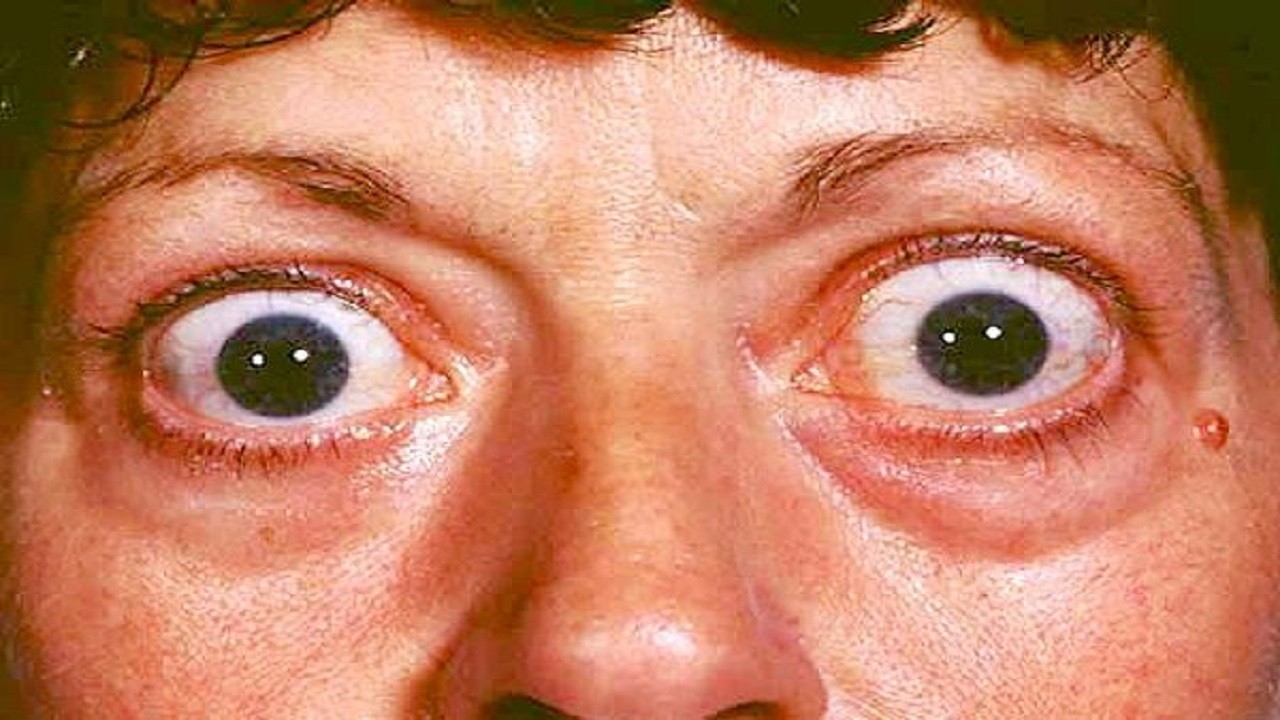 بیماری تیروئید چشمی و علائم آن