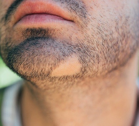 علل ریزش موی صورت یا ریش (آلوپسی باربا) چیست؟