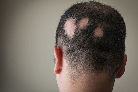 با انواع بیماری مو آشنا شوید و برای درمان آن اقدام کنید!