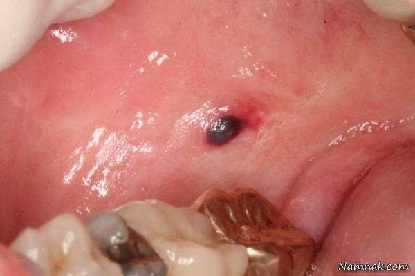 علل و راههای درمان تاول های خونی در دهان