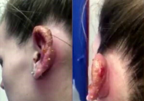 پیرسینگ پارتی؛ متهم ردیف اول هپاتیت