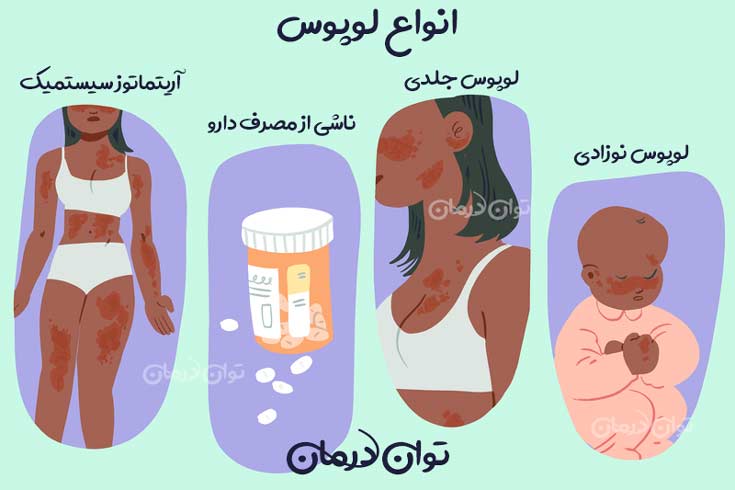 انواع لوپوس