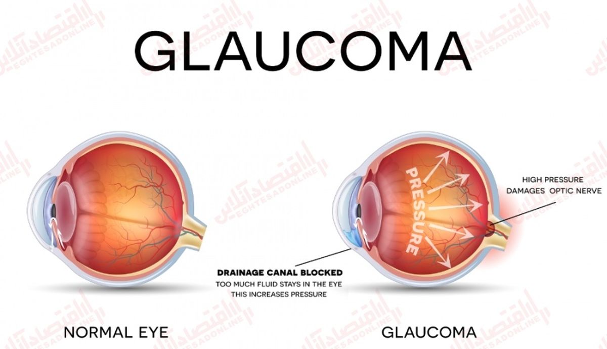 روز جهانی گلوکوم
