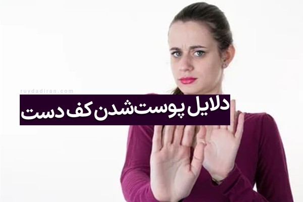 دلیل پوست پوست شدن کف دست