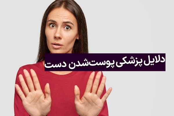 دلیل پوست پوست شدن کف دست