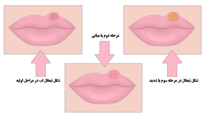 تبخال