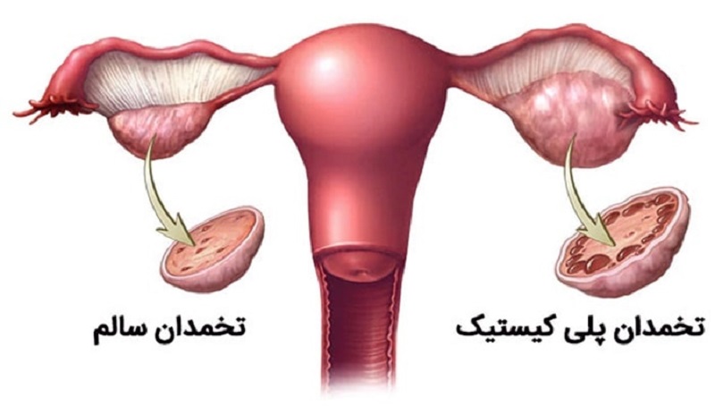 تنبلی تخمدان