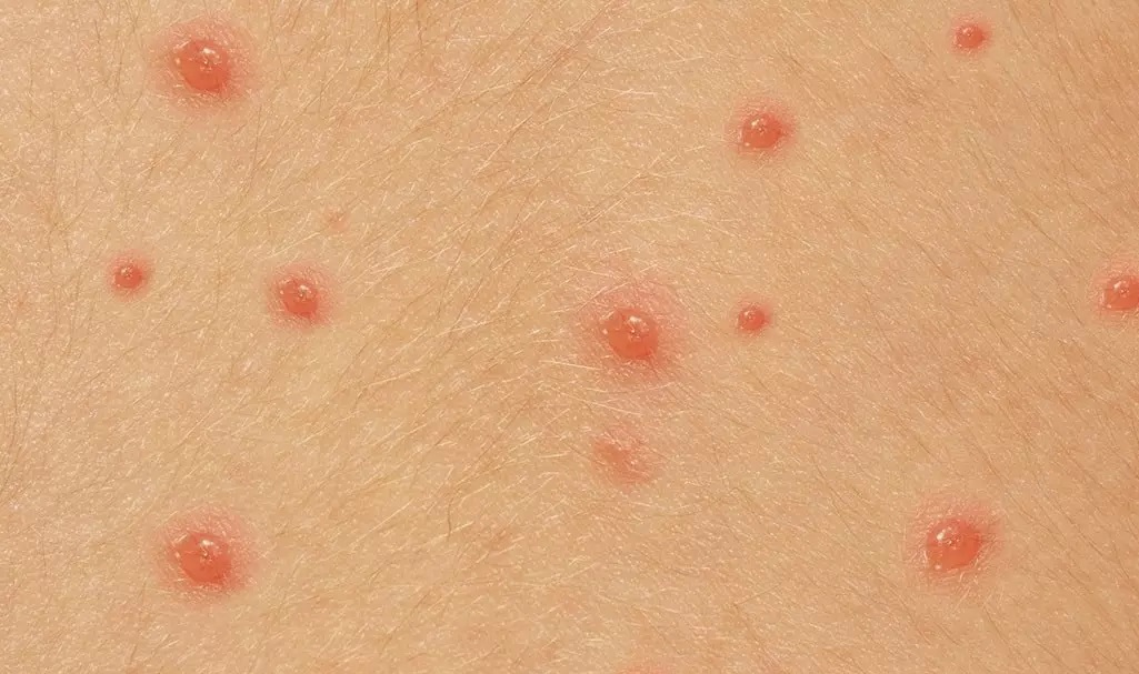 شکل جوشهای ابله مرغان